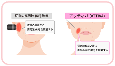 従来の高周波とATTIVA(アッティバ)の違い