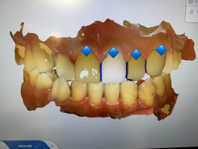 即日審美歯科治療における3D/CAD上での歯のデザインの様子。青印がセラミックのデザインが終わったところ。