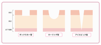 凹みの種類