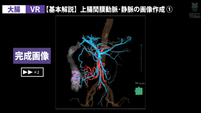 3DCT 大腸