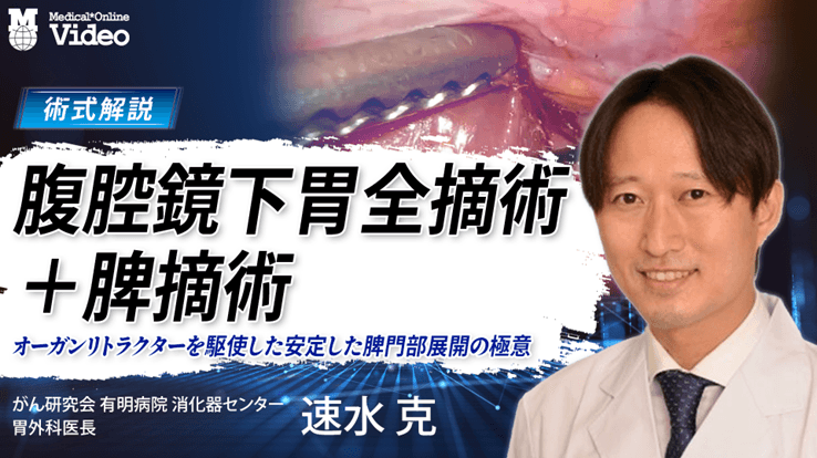 腹腔鏡下胃全摘術＋脾摘術