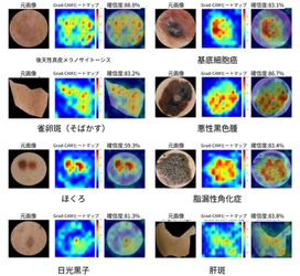 8種類の色素性皮膚病変を高精度で判別　診断根拠を可視化するAIを開発、医療現場への導入に期待