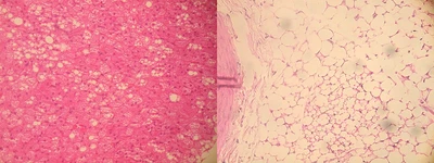 脂肪分と糖分の過剰摂取では血管異常の発生部位が異なることを発見　新たな血管疾患予防法の開発に期待
