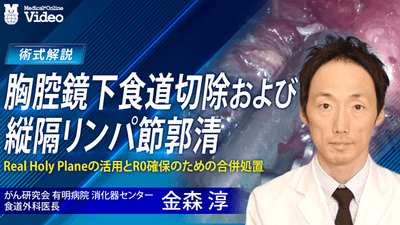 胸腔鏡下食道切除および縦隔リンパ節郭清