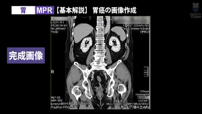 3D画像製作 胃