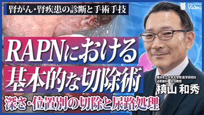 腎がん RAPNにおける基本的な切除術