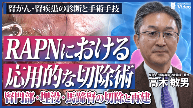 腎がん RAPNにおける応用的な切除術