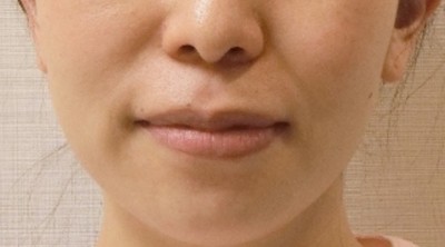 矯正治療前。歯並びが原因で左で噛む癖がある状態