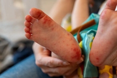 1歳前後で手足口病が増加中
親子で知っておきたい症状と対策